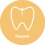 Fissure (1)