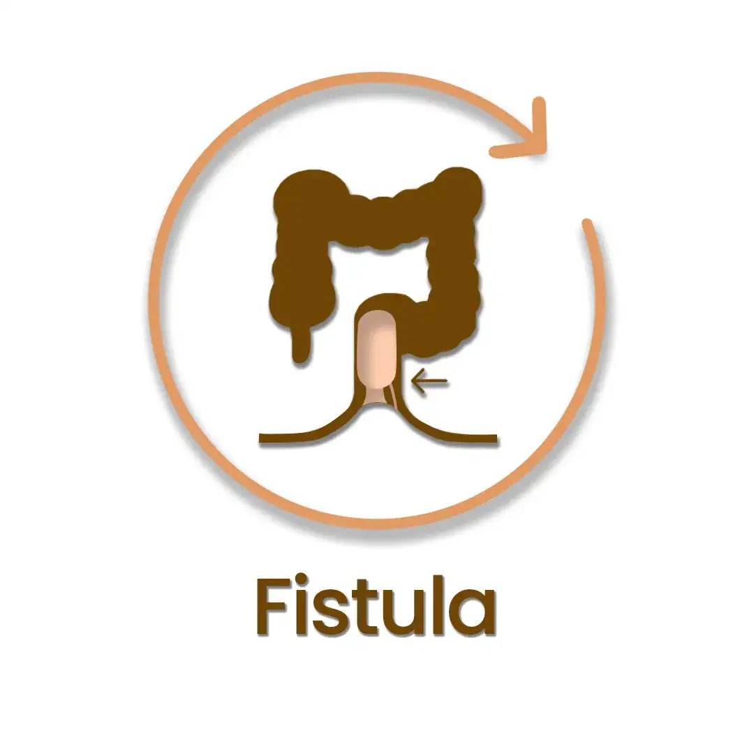 Fistula-2